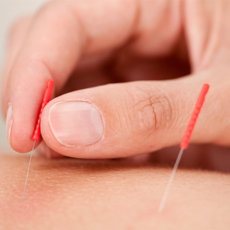 Chiropractic Wells ME Acupuncture